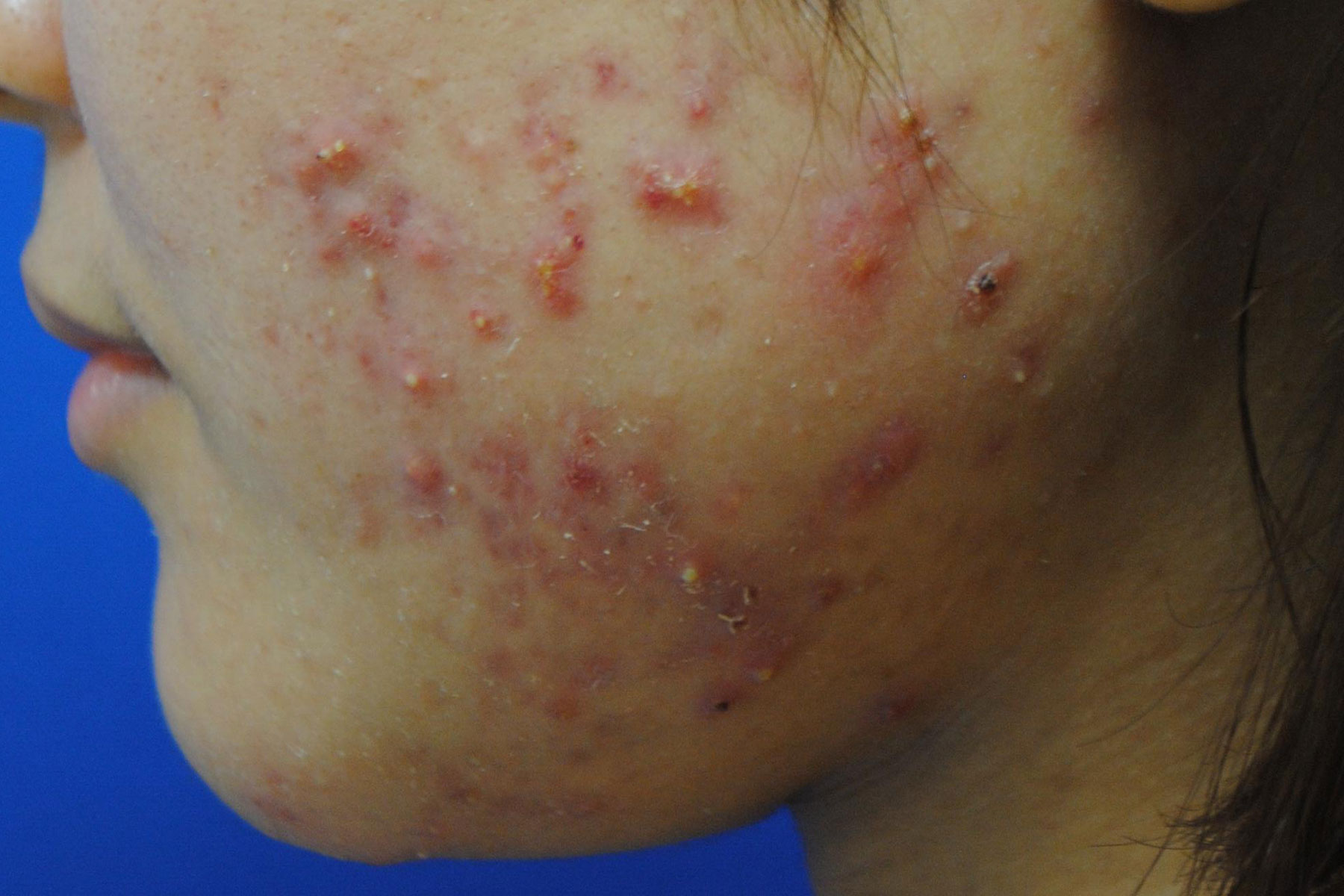 一晩でニキビを消すことは可能ですか？